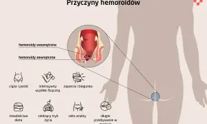 Ilustracja pokazuje przyczyny hemoroidów: ciążę, wysiłek fizyczny, zaparcia, dietę, siedzący tryb życia, seks analny, długie przebywanie w toalecie. Hemoroidy wyleczyłam.