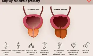 Ilustracja porównuje zdrową prostatę z zapaloną, pokazując objawy zapalenia prostaty: problemy z oddawaniem moczu, ból, pieczenie i zaburzenia erekcji.
