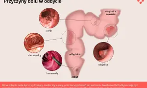 Ilustracja przedstawia przyczyny bólu w odbycie: polipy, stan zapalny, hemoroidy, raka jelita. Dyschezja może być objawem tych schorzeń.