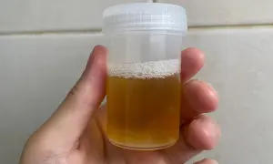 Pojemnik z żółtym moczem, gotowy do badania. Ile ml moczu do badania? Około 50 ml.