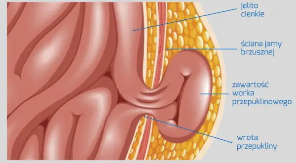 Przekrój anatomiczny uwidacznia przepuklinę brzuszną: jelito cienkie przechodzi przez wrotę przepukliny, tworząc zawartość worka przepuklinowego w ścianie jamy brzusznej.