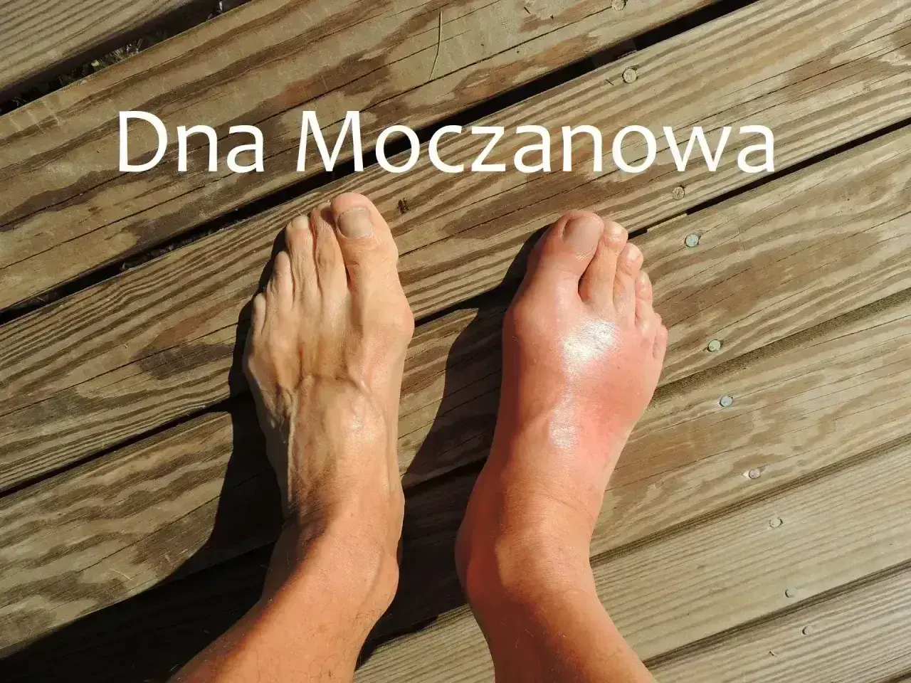 Stopa z obrzękiem i zaczerwienieniem, objawem dny moczanowej. Zastanawiasz się, ile się żyje z dna moczanowa?