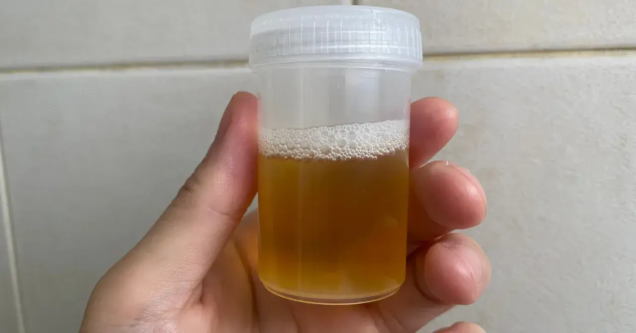 Pojemnik z żółtym moczem, gotowy do badania. Ile ml moczu do badania? Około 50 ml.