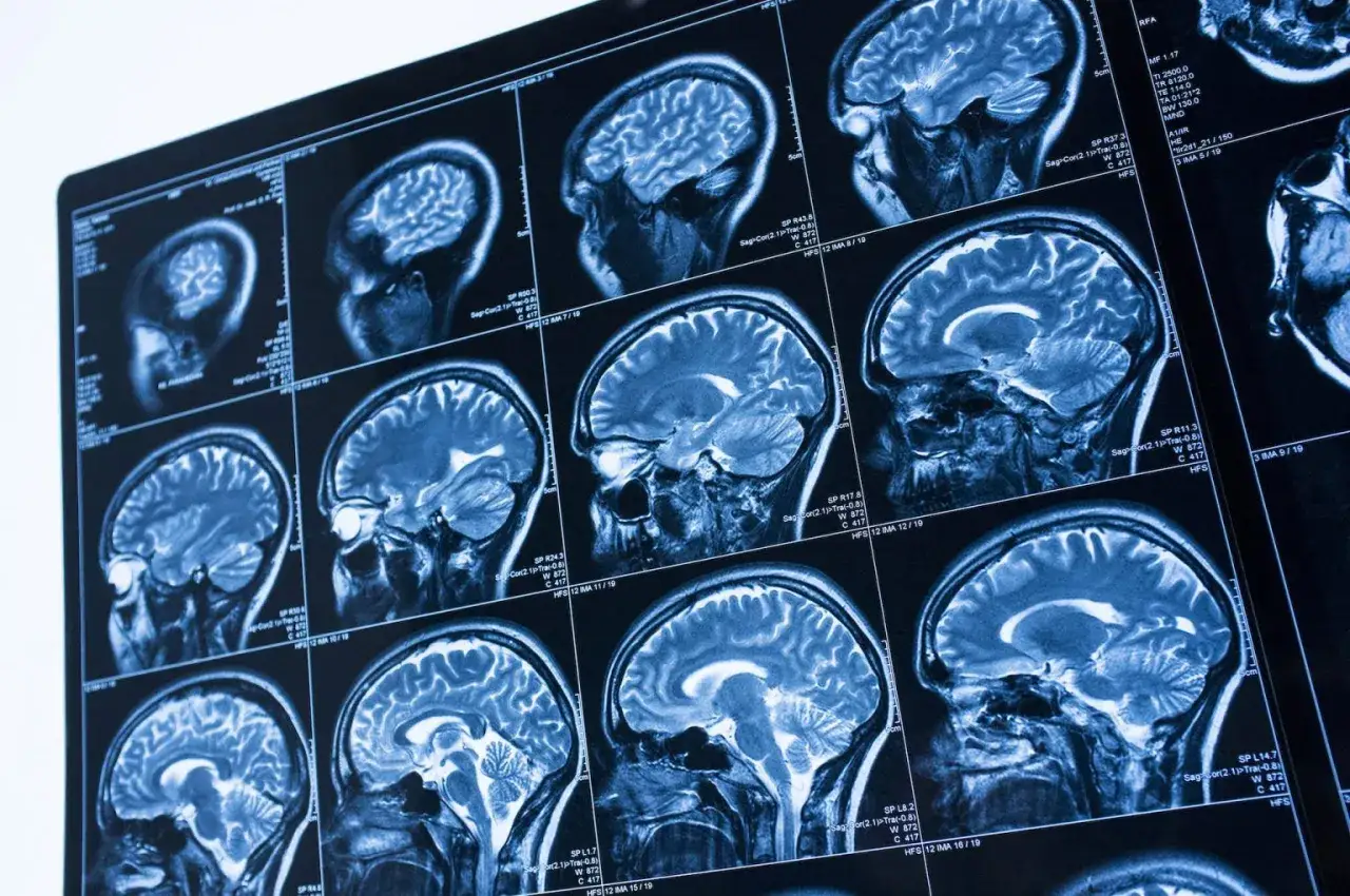 Sekwencja obrazów mózgu wykonana techniką rezonansu z kontrastem. Widoczne przekroje ukazują szczegółową anatomię mózgu.