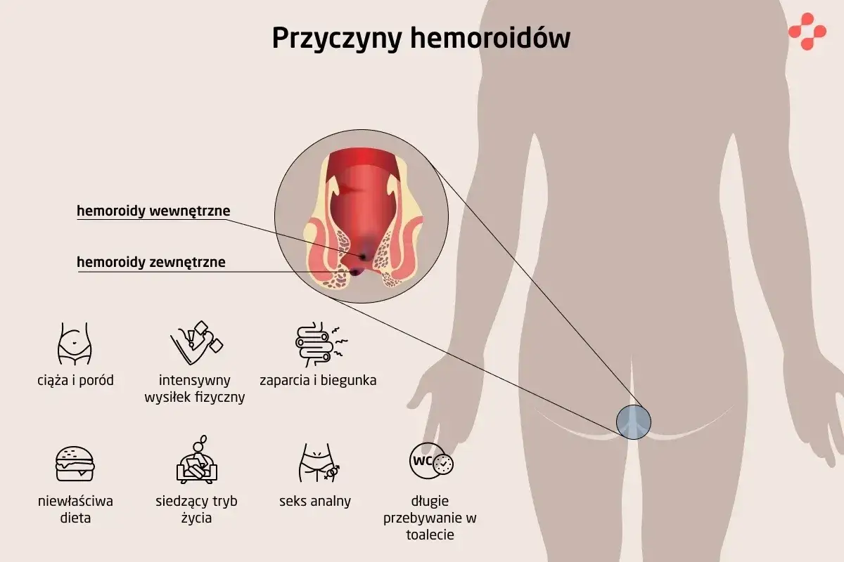 Ilustracja pokazuje przyczyny hemoroidów: ciąża, wysiłek fizyczny, zaparcia, dieta, siedzący tryb życia, seks analny, długie przebywanie w toalecie. Hemoroidy wyleczyłam.